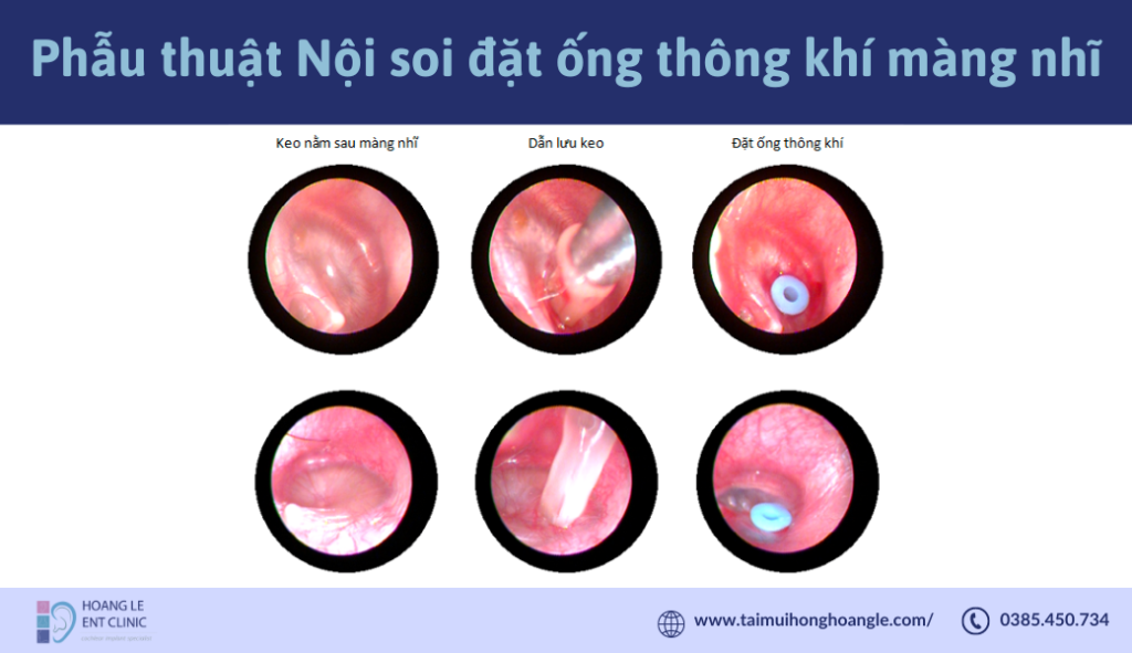 Phẫu thuật nội soi đặt ống thông khí màng nhĩ - Phòng Khám Tai Mũi Họng ...