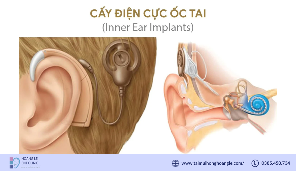 dien-cuc-oc-tai