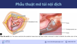 phau-thuat-mo-tui-noi-dich