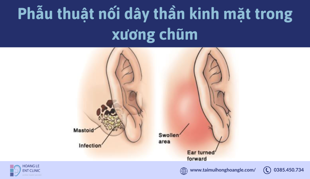 phau-thuat-noi-day-than-kinh-mat-trong-xuong-chum