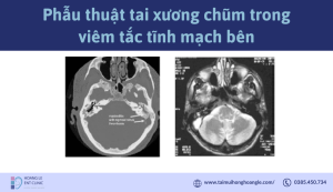 phau-thuat-tai-xuong-chum-trong-viem-tac-tinh-mach-ben