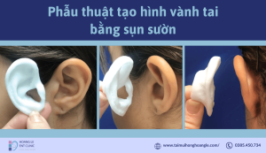 phau-thuat-tao-hinh-vanh-tai-bang-sun-suon