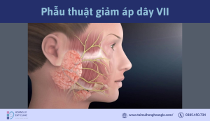 phau-thuat-giam-ap-day-VII