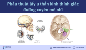 phau-thuat-lay-u-than-kinh-thinh-giac-duong-xuyen-me-nhi