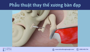 phau-thuat-thay-the-xuong-ban-dap