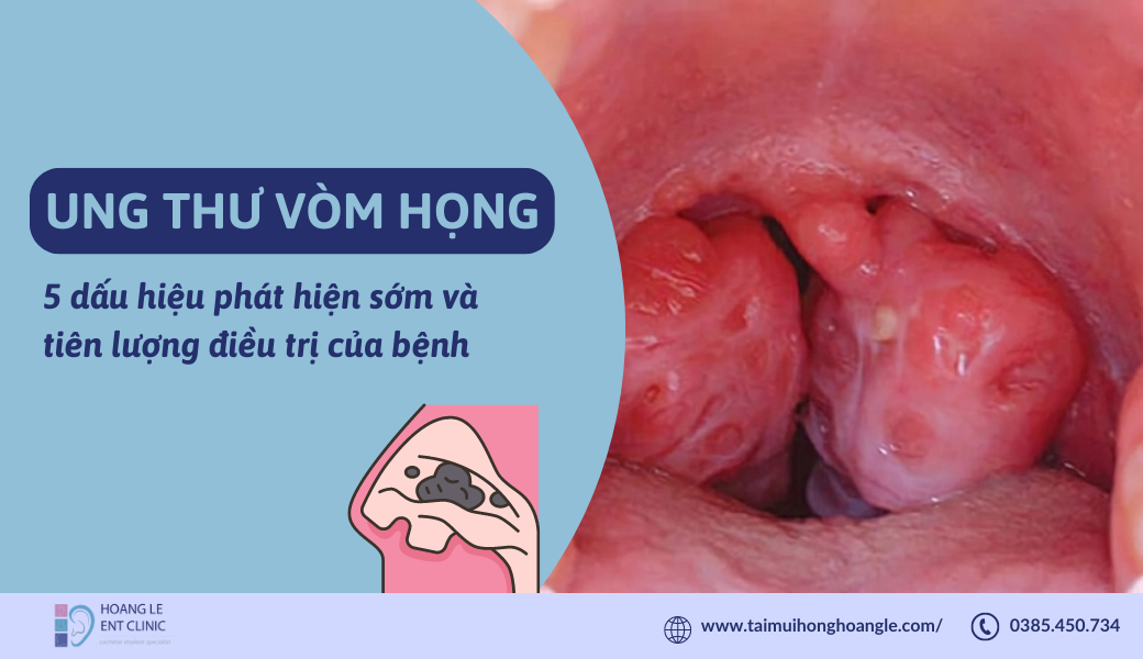 7. Lời khuyên từ các chuyên gia về việc nhận diện triệu chứng ung thư vòm họng