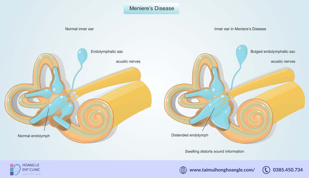 benh-meniere