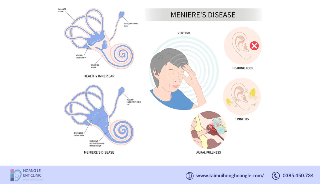 benh-meniere