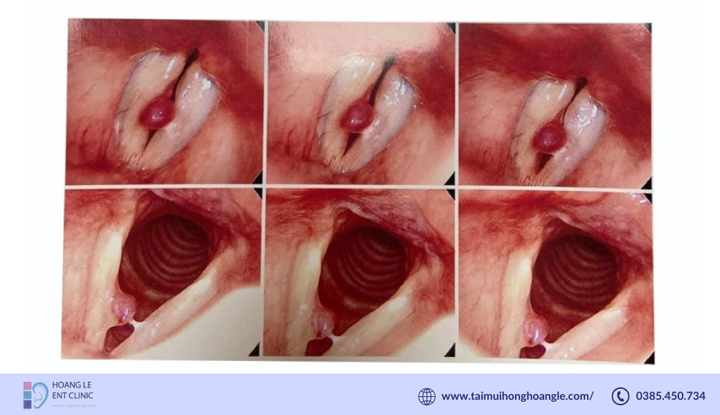 polyp-day-thanh (1)